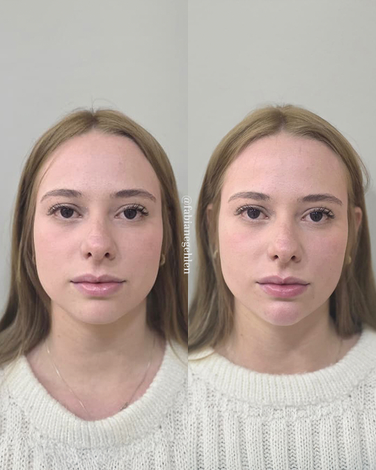 Harmonizacao Facial_Pato_Branco_10