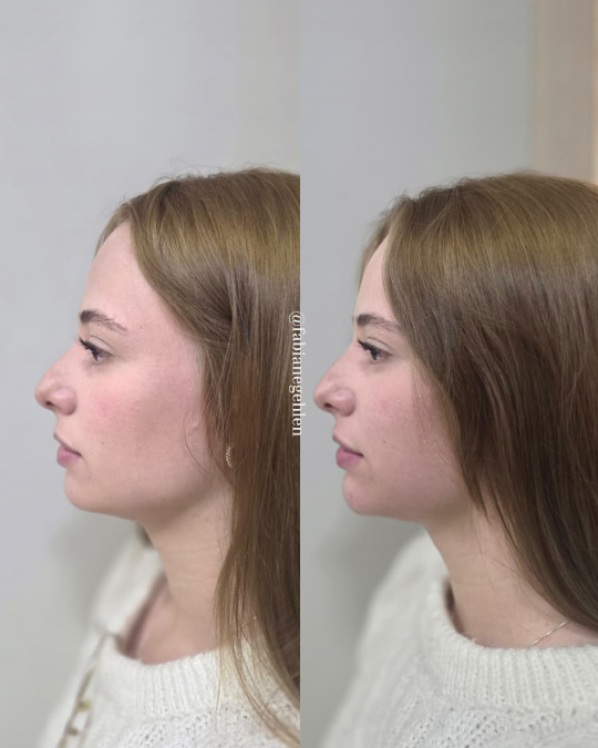 Harmonizacao Facial_Pato_Branco_11