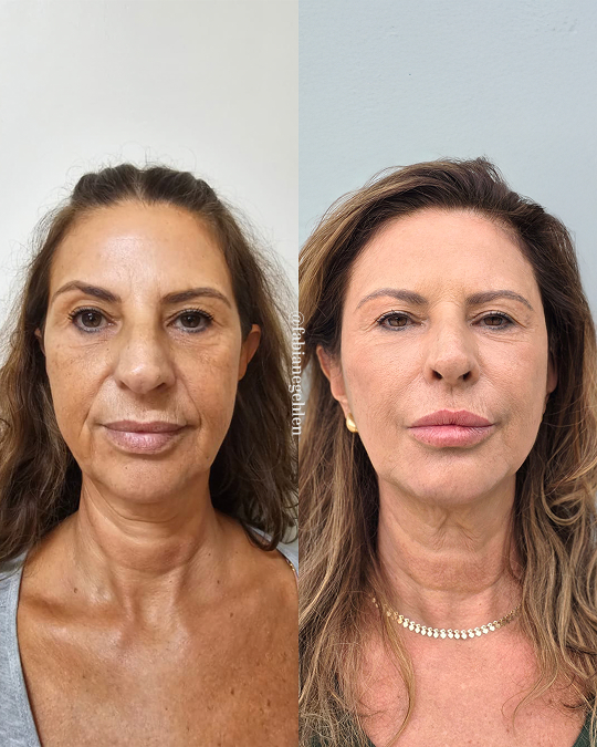 Harmonizacao Facial_Pato_Branco_12