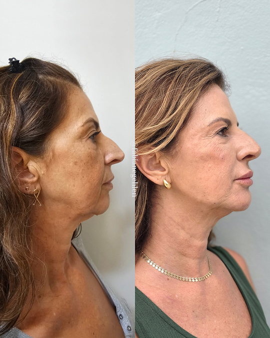 Harmonizacao Facial_Pato_Branco_13