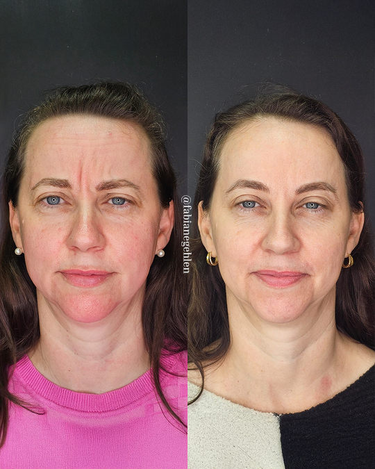Harmonizacao Facial_Pato_Branco_15