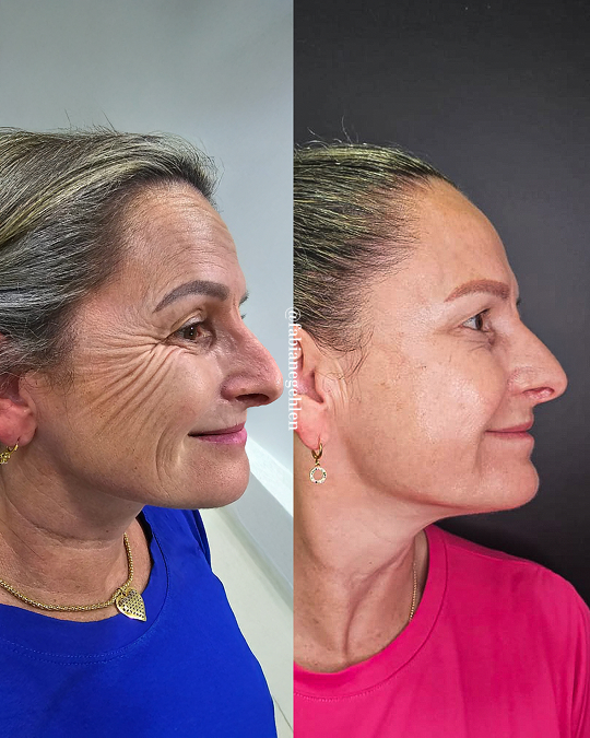 Harmonizacao Facial_Pato_Branco_16