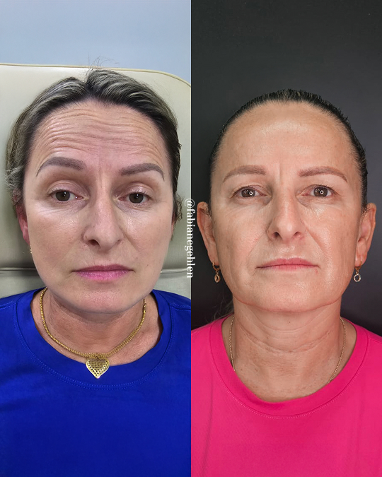 Harmonizacao Facial_Pato_Branco_17