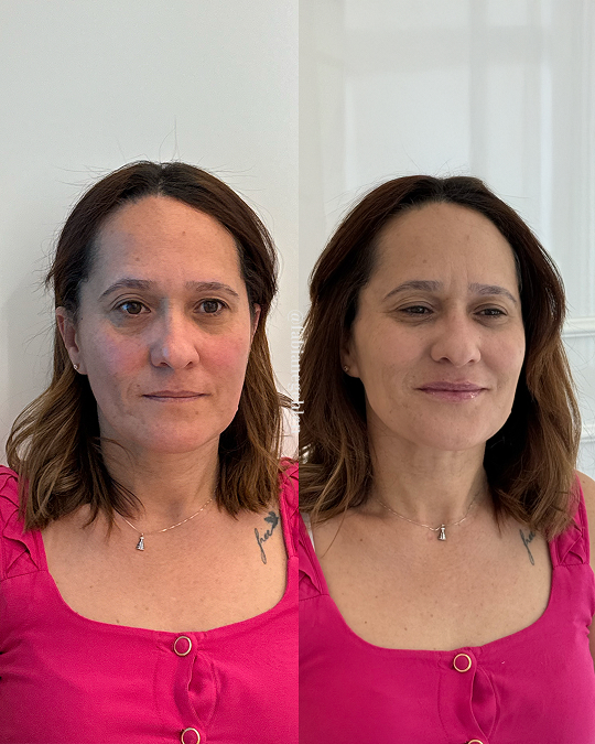 Harmonizacao Facial_Pato_Branco_18