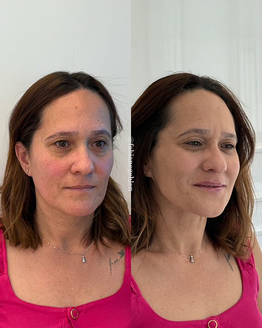 Harmonizacao Facial_Pato_Branco_19