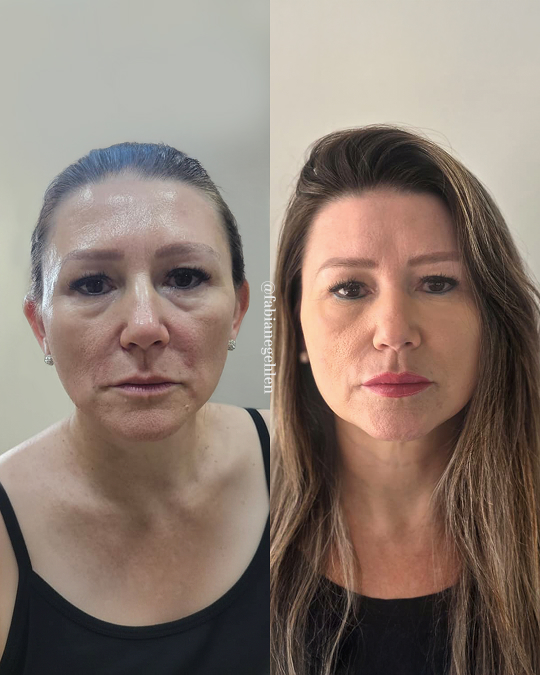 Harmonizacao Facial_Pato_Branco_20